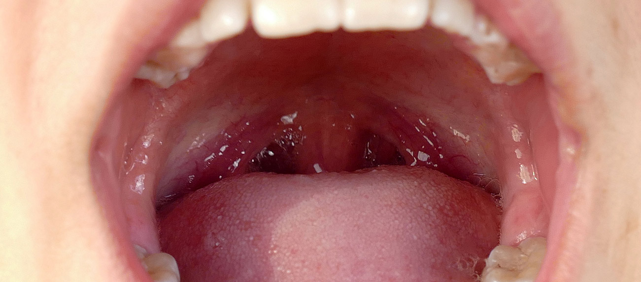 What Are Tonsil Stones and What Do I Do About Them?